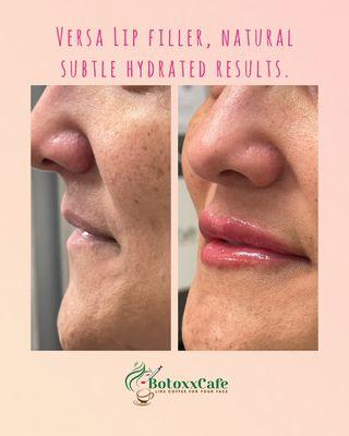 Client wanted natural lip filler without looking like duck lips. We delivered.