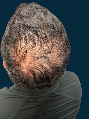 PRP Hair Restoration Before