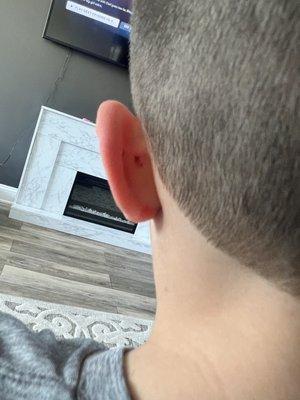 Ear bleeding