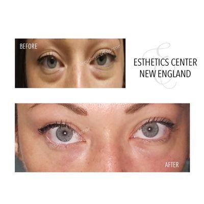 Dermal Filler to the Tear Trough area.  https://youtu.be/SOpHVtvTdls