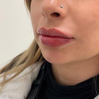 Lip filler