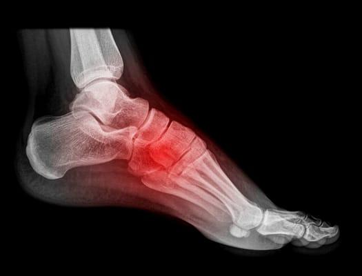 Ankle, foot and plantar fasciitis rehab