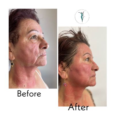 Microneedling anti-aging treatment