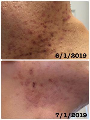 Deep clean treatment in one month