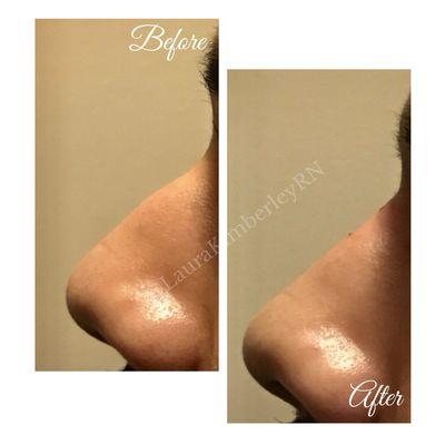 Nonsurgical rhinoplasty