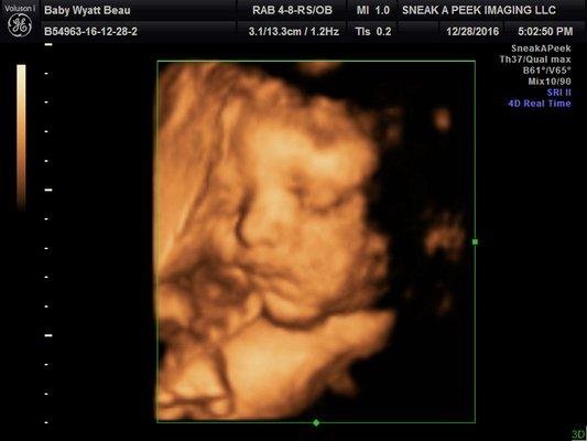 3D Ultrasound houston pictures at 24 Weeks