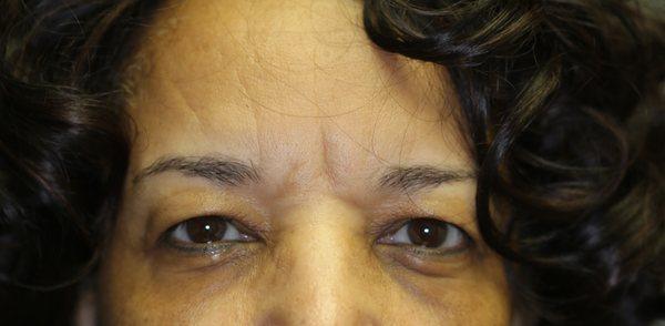 Before- Upper Blepharoplasty