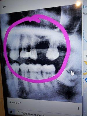 The upper molars are ruined.