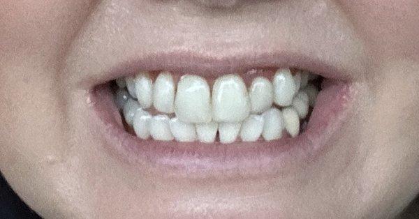 My teeth after cleaning and laminate at Aura Dental.