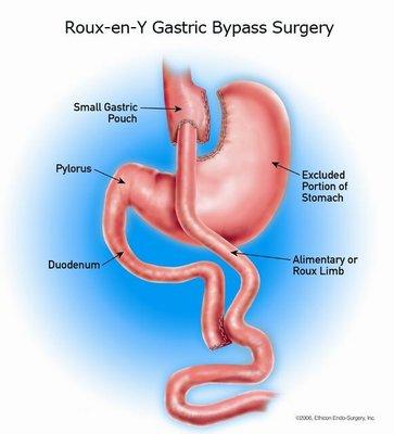 Laparoscopic Roux-en-Y Gastric Bypass