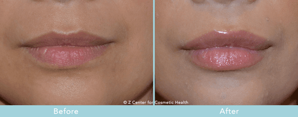 Lip fillers by Dr. Michael Zadeh