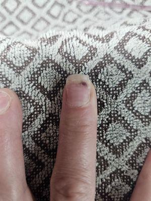 Fungus under my nail