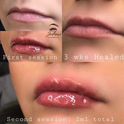 After 2ml session Lip fillers