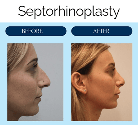 Before and after septo-rhinoplasty on one of of our sweet patients!