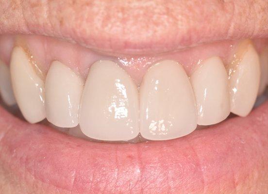 Replaced front 4 porcelain crowns - PFM's