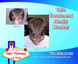 Laser Hair Therapy of Las Vegas