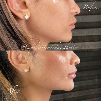 Enhance your natural beauty with cheek filler by sculpting a defined and more lifted profile. It's a quick way to add volume and contour.