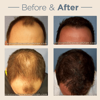 Hair Restoration Center of Utah