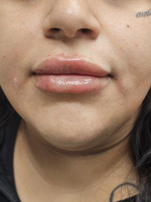 Cosmetic Lip Fillers