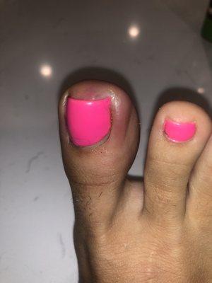 Infected toe