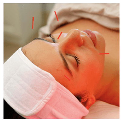 Mend offers a unique Acu-Facial which combines ancient Chinese acupuncture with modern heat therapies.