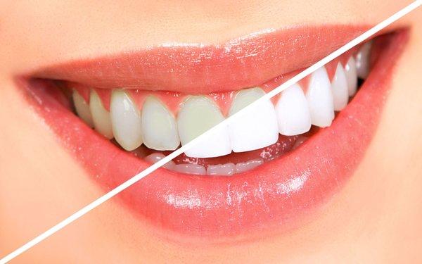 Teeth whitening services available!