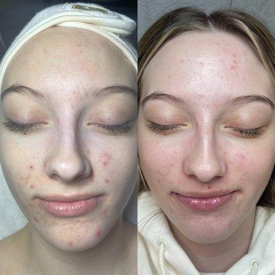 Skin transformation  (after 2 treatments)