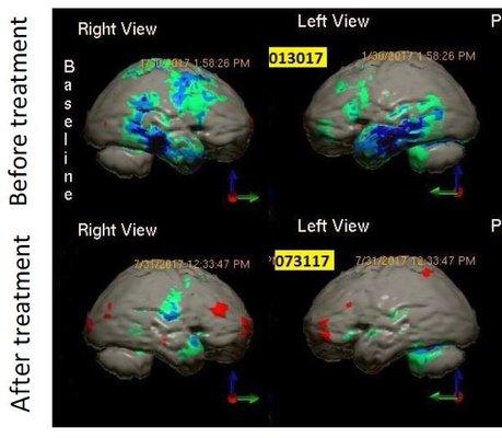 Brain scans showing dramatically improved brain function after treatment