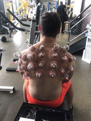 Cupping technique applied to client