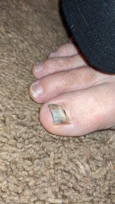 The nail on my big toe was mostly separated from the bed