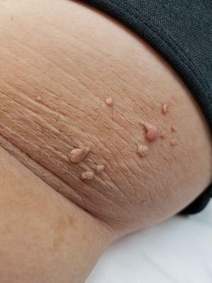 Skin tags