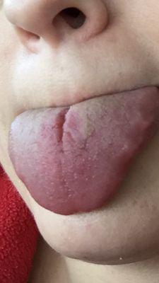 Fissure and tongue irritation