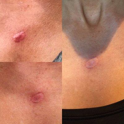 Scar improved drastically after only three treatments