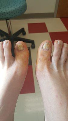 My toes after they numbed them.