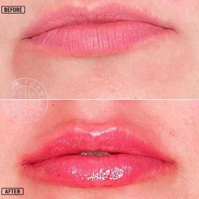 Lip filler before and after