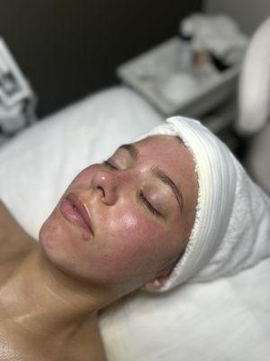 After: Hydro-dermabrasion facial