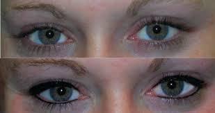 Before and after upper and Lower liner