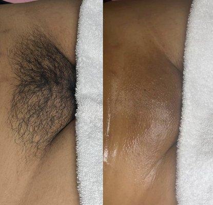 Brazilian Wax + Vagacial for ingrown & razor bump treatment