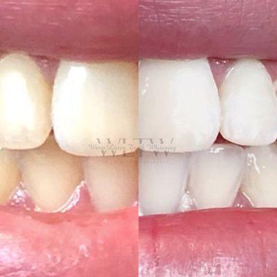 Waco Laser Teeth Whitening