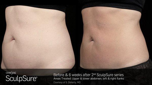 Before & After SculpSure