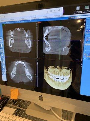 Mind blown. Crazy 3D scan tool which allowed Dr. Cajee to trace nerves around my tooth.