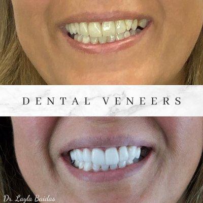 Dental Veneers