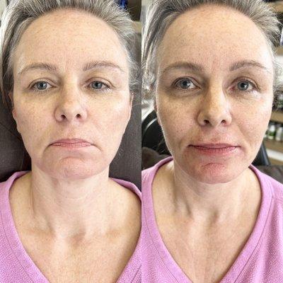 Lower face filler correction