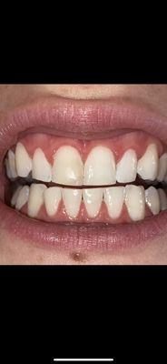 Before veneers from Dr.Haber