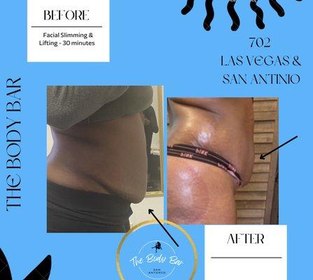 Las Vegas Body Sculpting- Non Surgical Tummy Tuck - Las Vegas Lymphatic Drainage