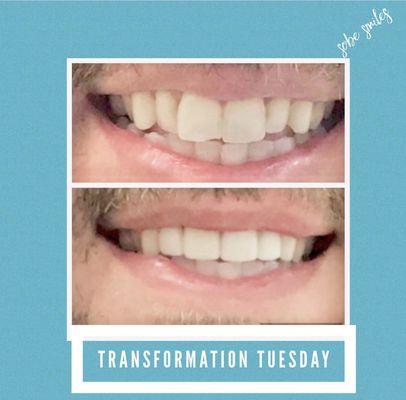 4 Veneers Changed this patients smile!