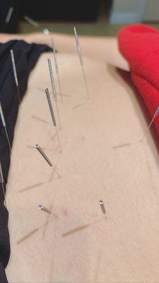 Acupuncture for irregular menstruation