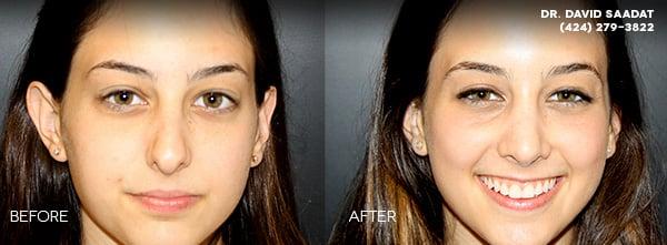 Recent Rhinoplasty Surgery Front View