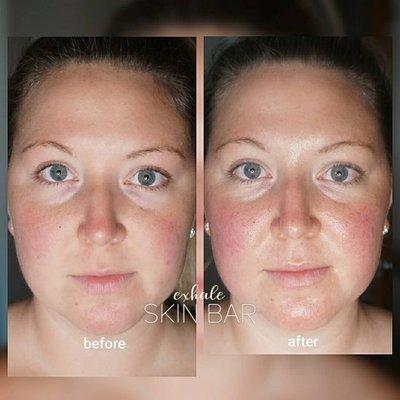 Sculptural Face Lifting w. Lymphatic Drainage & Gua Sha Results