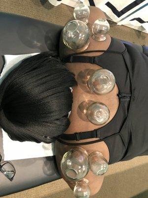 Cupping therapy is a wonderful stress reliever moving blood and qi, getting things flowing